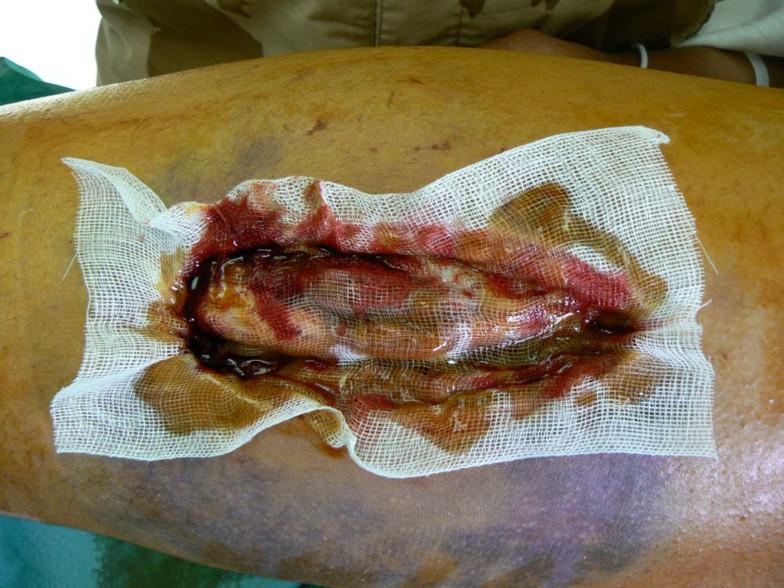 Antiseptisches Additiv verstärkt Hyaluronsäure