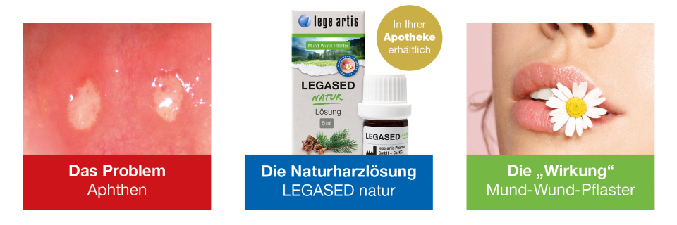 Das natürliche Mund-Wund-Pflaster bei Aphthen