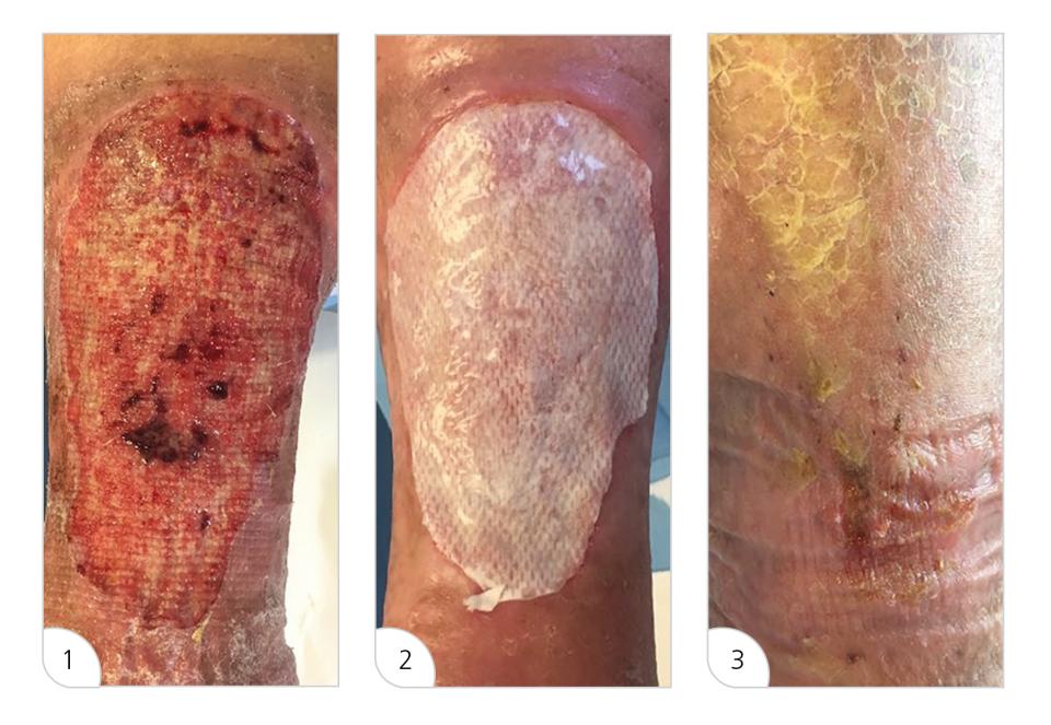 Fallbeispiel: Patientin, 70 Jahre, Ulcus cruris