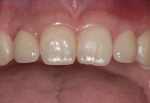 Abb. 25: Gesamtergebnis nach Augmentation 12 und 22 mit jeweils einem Transplantat von der Crista zygomatico-alveolaris u. implantatverankerten Kronen