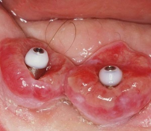Abb. 1: Klinisches Bild einer Mukositis mit deutlicher Entzündung der periimplantären Gewebe. (Foto: Lüpke)