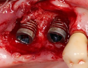 Abb. 2: Intraoperatives Bild einer Periimplantitis mit teilweisem Verlust der Oesseointegration. (Foto: Berger)