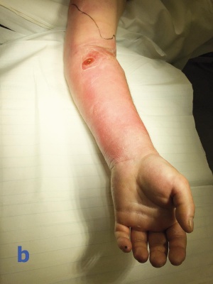 Abb. 1: Unmittelbarer präoperativer Befund: Bild a zeigt die ehemalige Punktionsstelle des intravenösen Zugangs, auf Bild b sind Rötung und Schwellung des Unterarms bei abgeblasster Hand gut erkennbar. Auf Bild c sieht man das deutliche Abblassen der Umgebung bei Berühren des prall gespannten Unterarms.