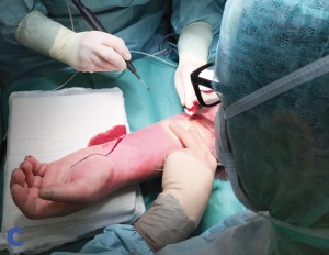 Abb. 1: Unmittelbarer präoperativer Befund: Bild a zeigt die ehemalige Punktionsstelle des intravenösen Zugangs, auf Bild b sind Rötung und Schwellung des Unterarms bei abgeblasster Hand gut erkennbar. Auf Bild c sieht man das deutliche Abblassen der Umgebung bei Berühren des prall gespannten Unterarms.