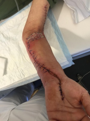 Abb. 4: Befund nach partiellen Sekundärverschluss (Bild a) und cubitaler Spalthautransplantation (Bild b)