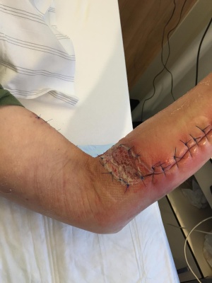 Abb. 4: Befund nach partiellen Sekundärverschluss (Bild a) und cubitaler Spalthautransplantation (Bild b)
