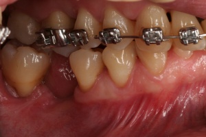 Abb. 5: Patient, männlich, 31 Jahre, erstdiagnose: Generalisierte aggressive Parodontitis mit alio loco begonnener aktiver KFO-Therapie.
Abb. 5a: Zustand nach PAR-Therapie, Alveolarmukosa reicht über Alveolarkamm nach lingual.