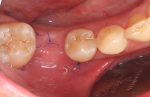 Abb. 5: Patient, männlich, 31 Jahre, erstdiagnose: Generalisierte aggressive Parodontitis mit alio loco begonnener aktiver KFO-Therapie.
Abb. 5b: Zustand nach BGT: einheilung regio 36 am 17. Tag post OP.