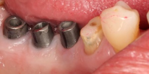 Abb. 6: Ausreichend keratinisierte Gingiva periimplantär regio 46 – 47.