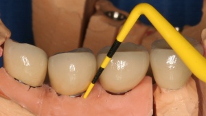 Abb. 7: Patient, männlich, 54 Jahre, Zustand nach Behandlung einer generalisierten moderaten chronischen Parodontitis, seit einem Jahr Nichtraucher, hypertonie, seit zwei Jahren in UPT.
Abb. 7a: Sondieren mit Silikonzahnfleischmaske.