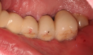 Abb. 9: Patient, männlich, 47 Jahre, Zustand nach Behandlung einer generalisierten moderaten chronischen Parodontitis und Mukositis, Nichtraucher, hypertonie, metabolisches Syndrom, vier Jahre in UPT mit Unterbrechung.
Abb. 9a: Spiegelansicht regio 24 bis 26 von palatinal.