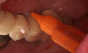 Abb. 9: Patient, männlich, 47 Jahre, Zustand nach Behandlung einer generalisierten moderaten chronischen Parodontitis und Mukositis, Nichtraucher, hypertonie, metabolisches Syndrom, vier Jahre in UPT mit Unterbrechung.
Abb. 9b: Spiegelansicht regio 24 bis 26 von palatinal: Reinstruktion zur Zahnzwischenraumreinigung.
