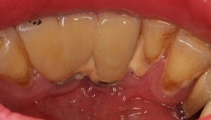 Abb. 9: Patient, männlich, 47 Jahre, Zustand nach Behandlung einer generalisierten moderaten chronischen Parodontitis und Mukositis, Nichtraucher, hypertonie, metabolisches Syndrom, vier Jahre in UPT mit Unterbrechung.
Abb. 9c: Lingualansicht der UK – Front: Schlechte Reinigungsmöglichkeit für Patient der alio loco angefertigten Implantatprothetik.