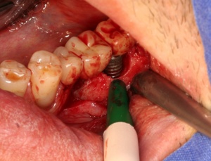 Abb. 15: Darstellung des knöchernen Defekts periimplantär 37.