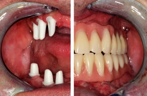 Abbildung 7: Konuskronen auf den eingebrachten Implantaten/implantatgetragene Prothetik.