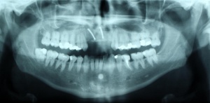 Abbildung 11: PSA: Z.n. Anlagerungsosteoplastik in der Oberkieferfront, Minischraubenosteosynthese.