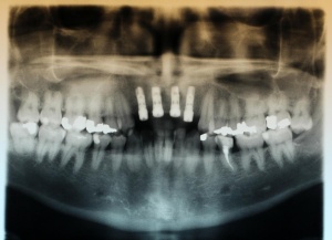 Abbildung 13: PSA: Z.n. Freilegung der Implantate 12, 11, 21, 22.