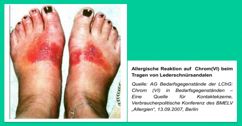 Darstellung der Ekzembildung nach Kontakt mit Chrom(VI)-haltigem Leder