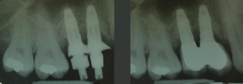 Radiologische Ausgangssituation, Regio 14/15 mit ausgeprägtem Defekt (li) und...