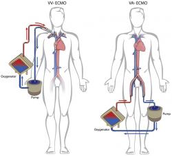 Schemazeichnung zur Technik der va- und vv-ECMO